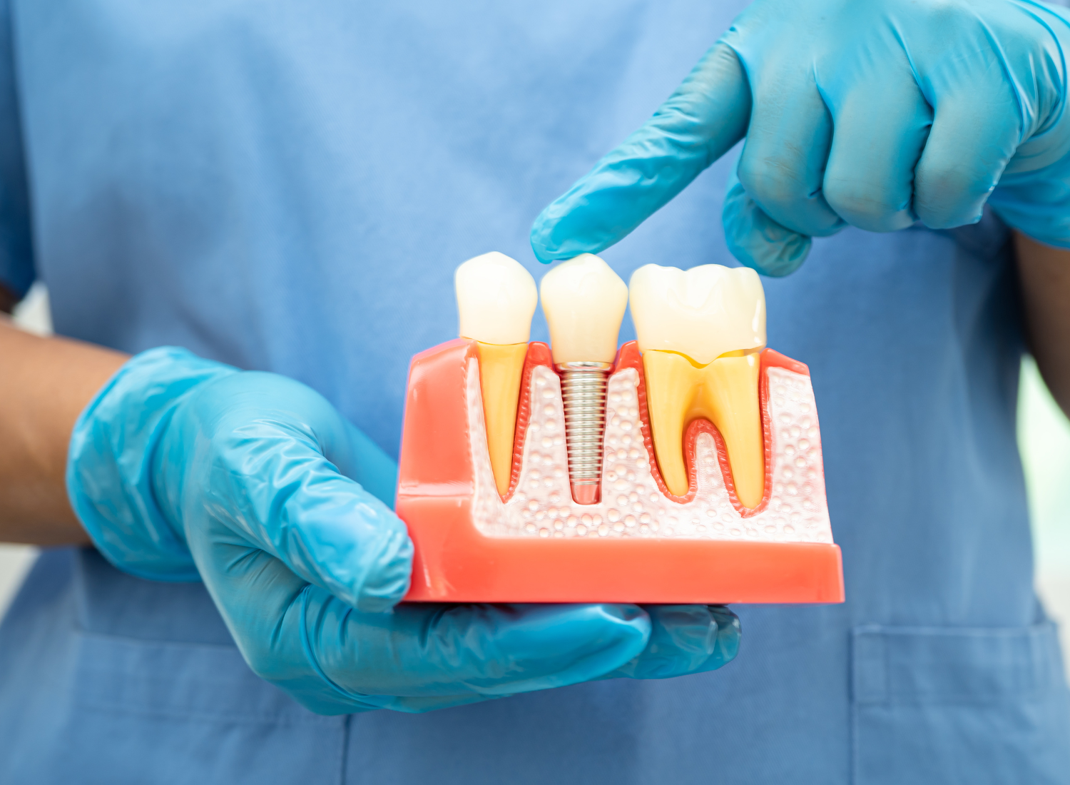 10 Signs You May Need a Root Canal Treatment