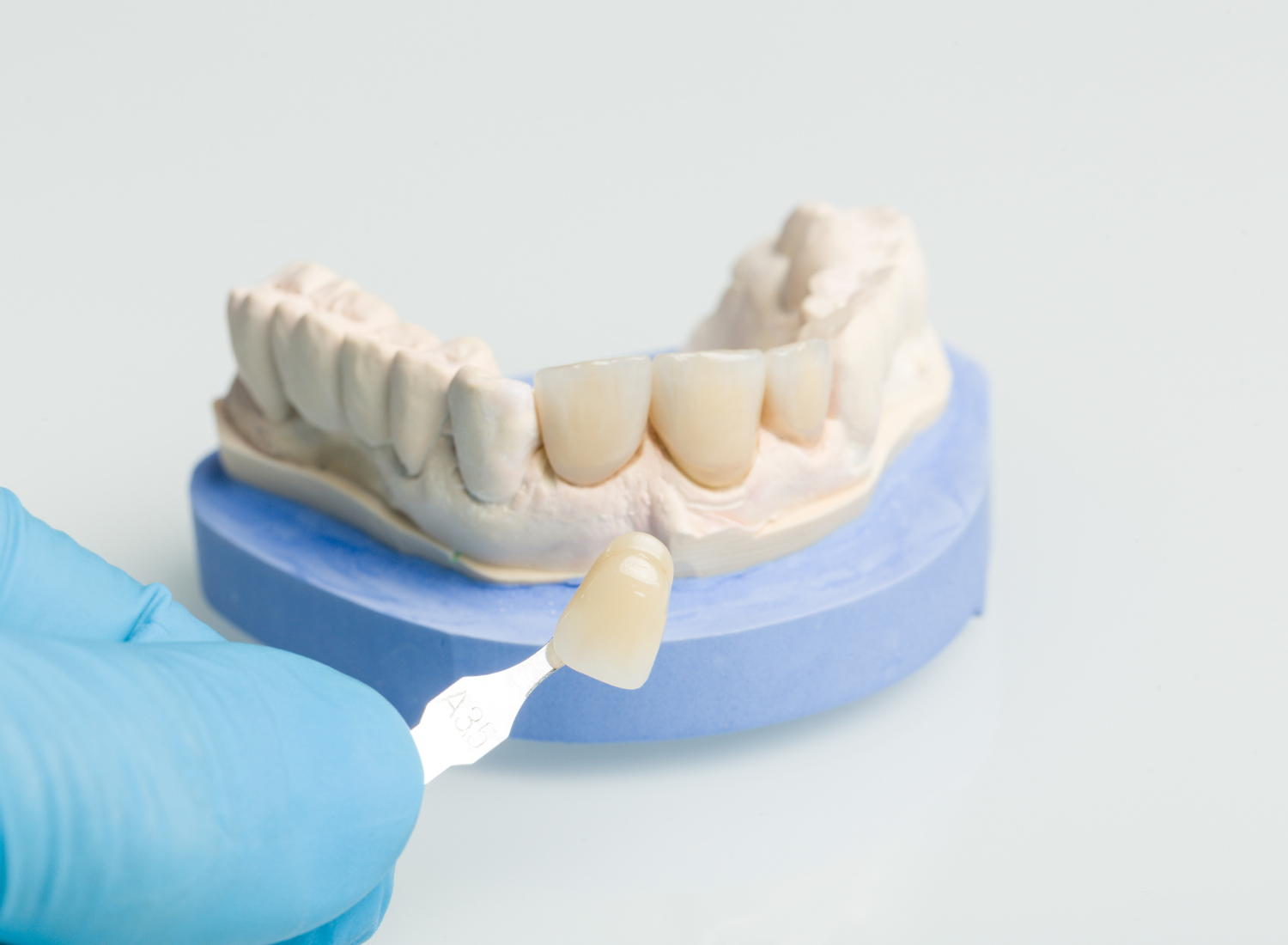 8 Reasons Why You Might Need a Dental Crown in Union City