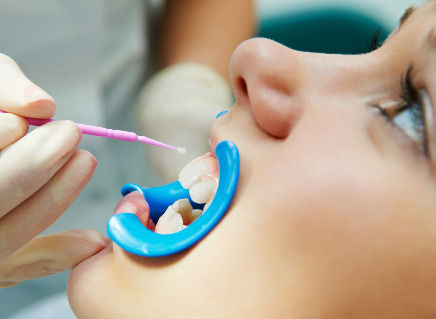 The Importance of Dental Sealants for Rockwall Families