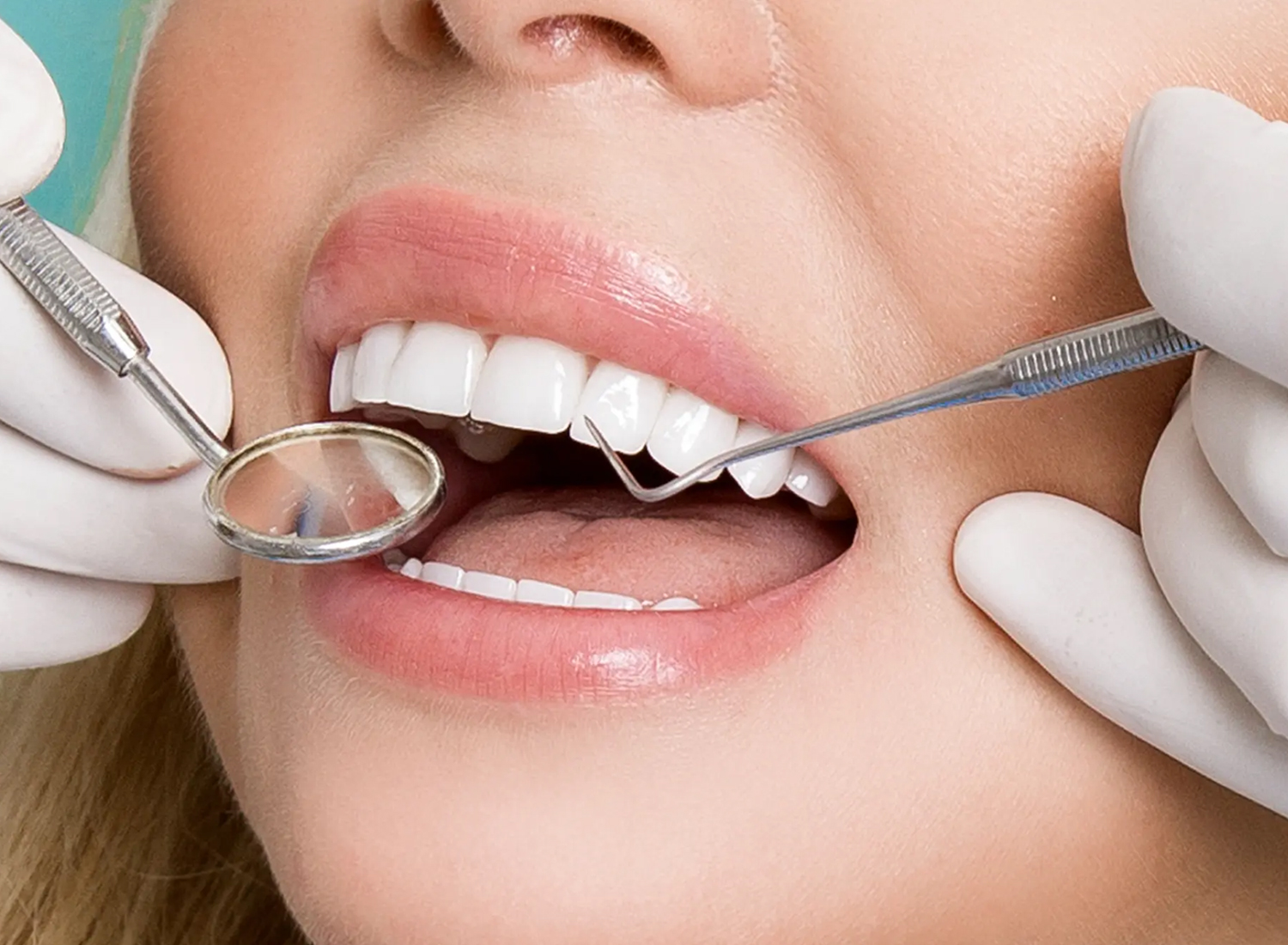 Quiet Glow-Ups: Dental Veneers Near Rockwall for a Subtle, Natural Smile