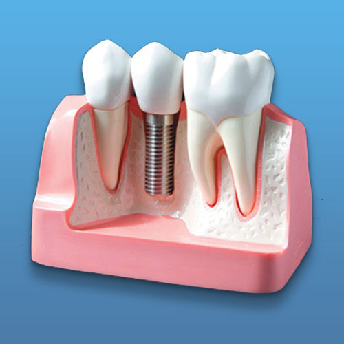 implant dentistry