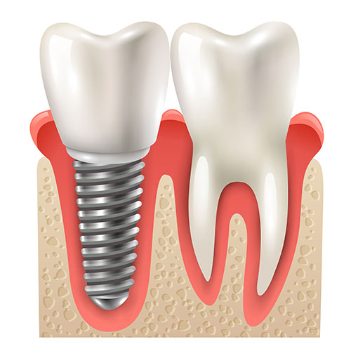 dental implant surgery