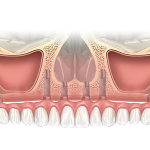 teeth implants