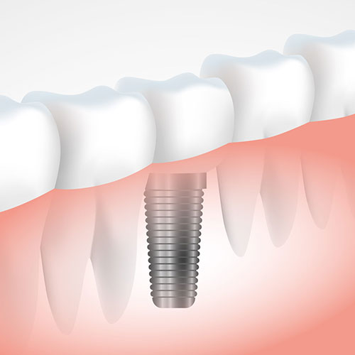 tooth implant procedure